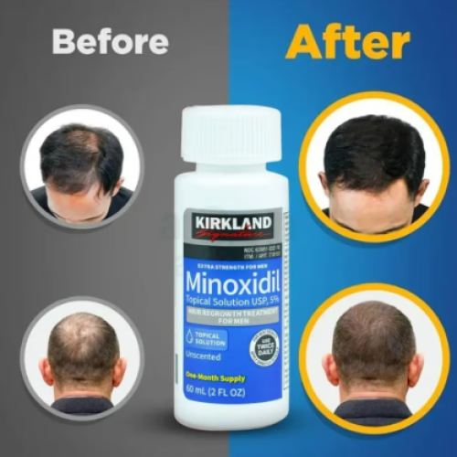 Kirkland 5% Minoxidil Hair Regrowth Treatment 60ml Price in Bangladesh